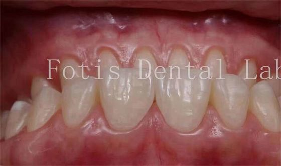 अनुकूलित प्राकृतिक दिखने वाले स्नैप ऑन फ़नीर 0.3mm-0.5mm मोटाई