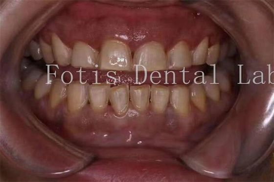 अनुकूलन चिकनी सतह बनावट के साथ चीनी मिट्टी के बरतन दांत veneers